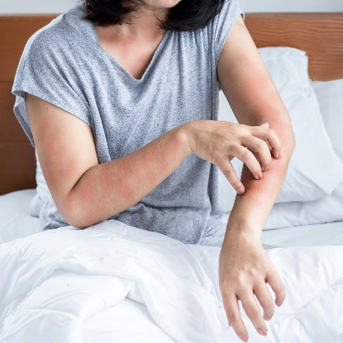 Bedbug Infestation
